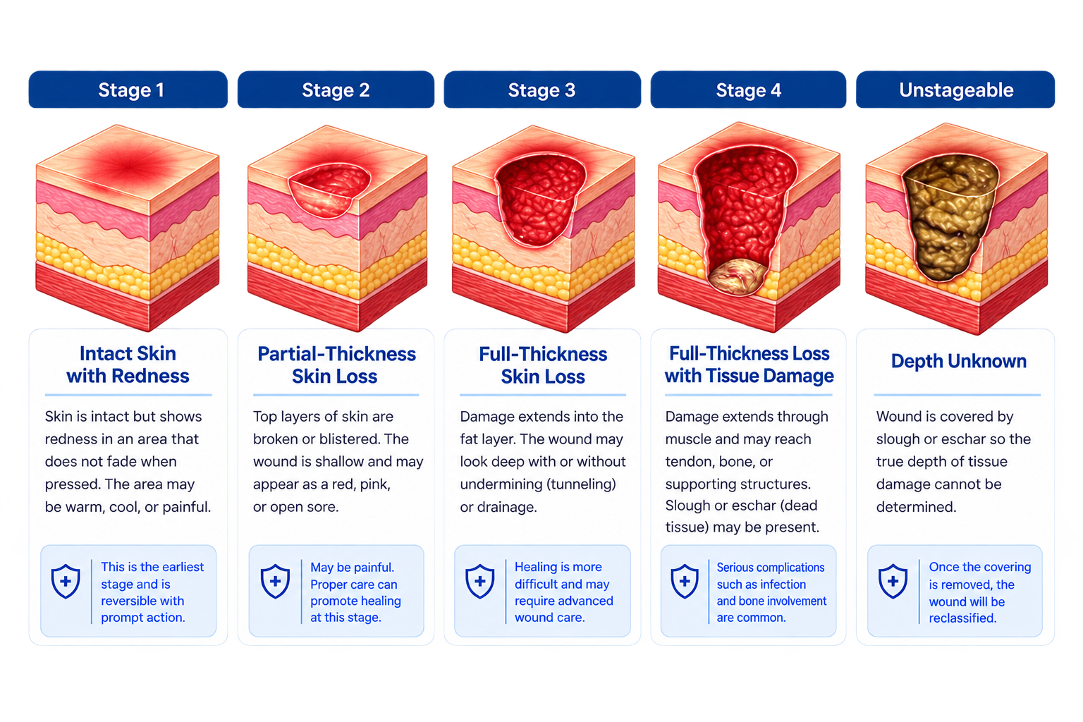 Medical illustration showing Stage 1, Stage 2, Stage 3, Stage 4 and unstageable pressure injuries with progressively deeper tissue damage